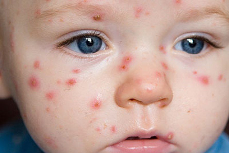 Chickenpox in children: Symptoms and safe treatment methods that mothers need to know.