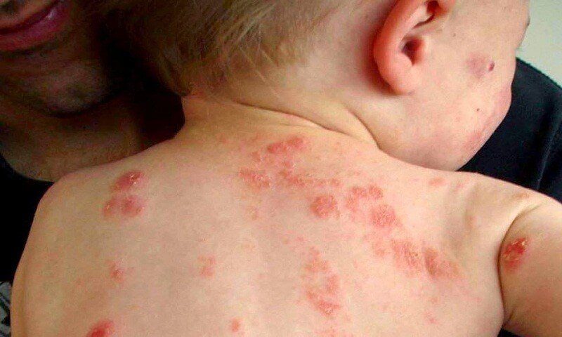 Is Pediatric Impetigo a Serious Concern? Clinical Signs and Expert Care Guidelines