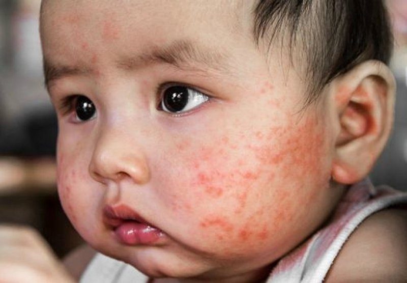 Eczema in children: Symptoms, causes, and proper care methods.