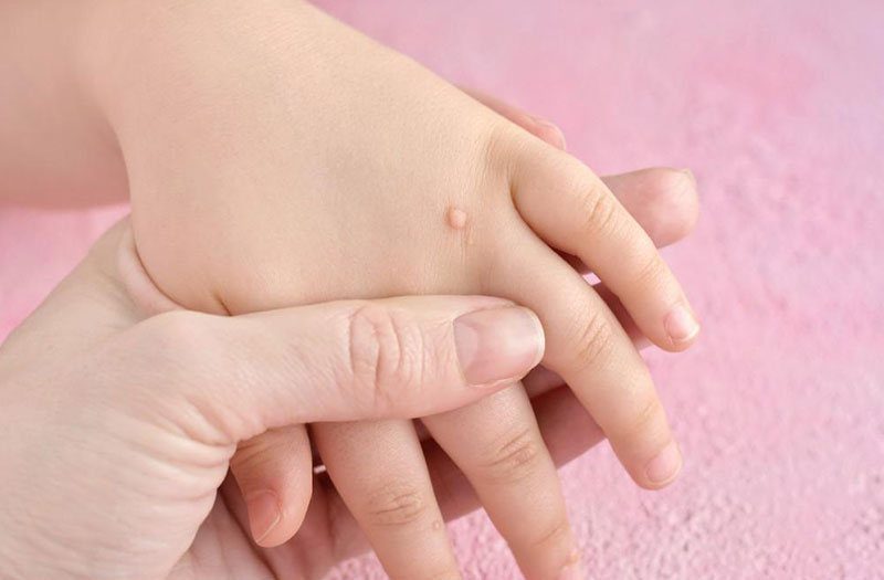 Pediatric Warts Are Highly Common: Underlying Causes and Effective Treatments
