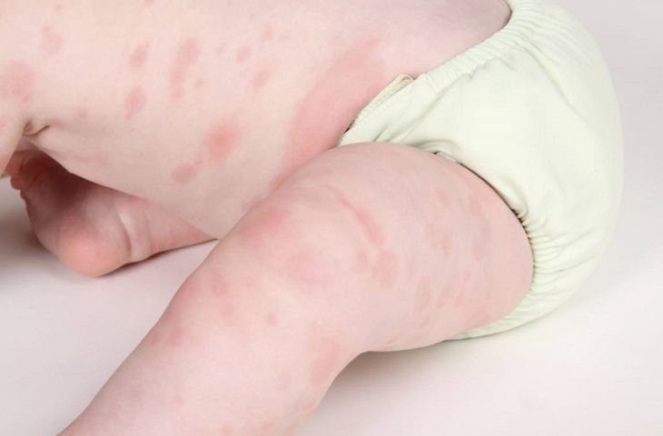 Allergic dermatitis in children: Causes, symptoms, and treatment methods.