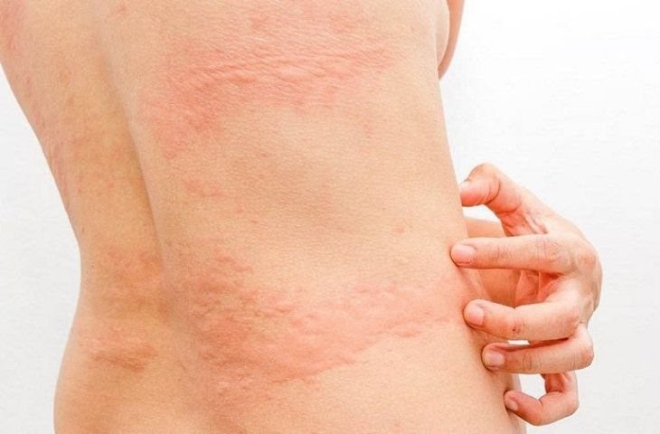 Essential Pediatric Urticaria (Hives) Care: A Comprehensive Guide for Mothers