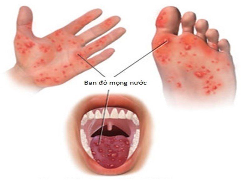 Pediatric Hand, Foot, and Mouth Disease: Recognizing Critical Complications