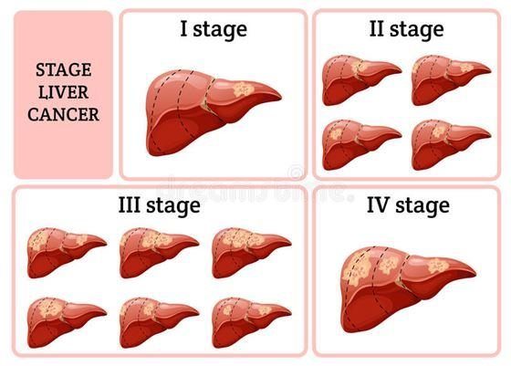 The stages of liver cancer based on analysis and diagnosis