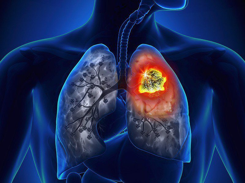 Symptoms of lung cancer - early signs to recognize, early treatment.