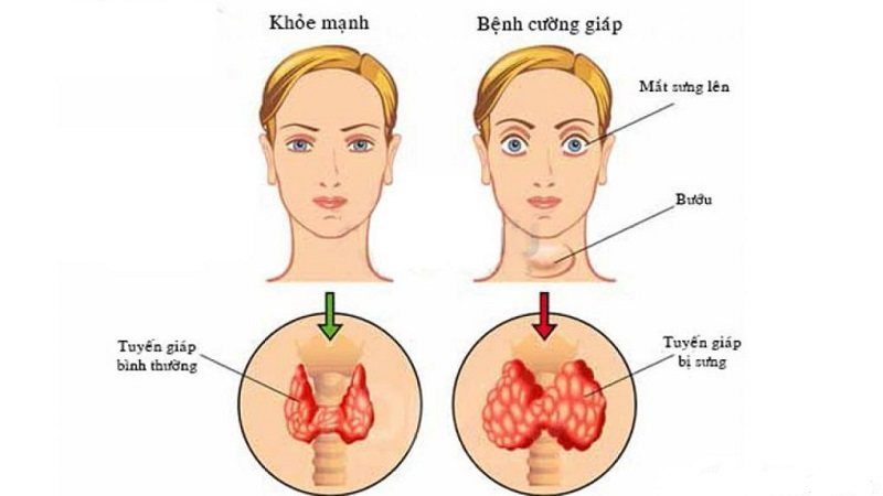 What is hyperthyroidism? Causes, symptoms, and treatment methods.
