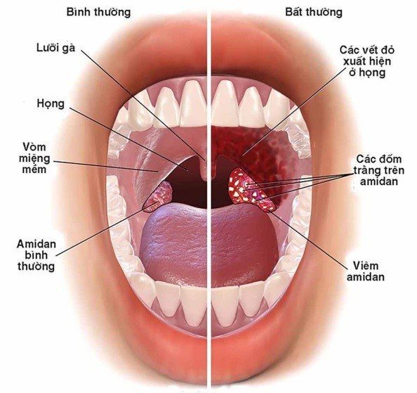 What causes a sore throat? Symptoms and treatment methods.