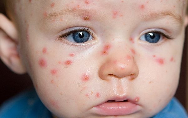 What Causes Boils in Young Children, and How Are They Treated?