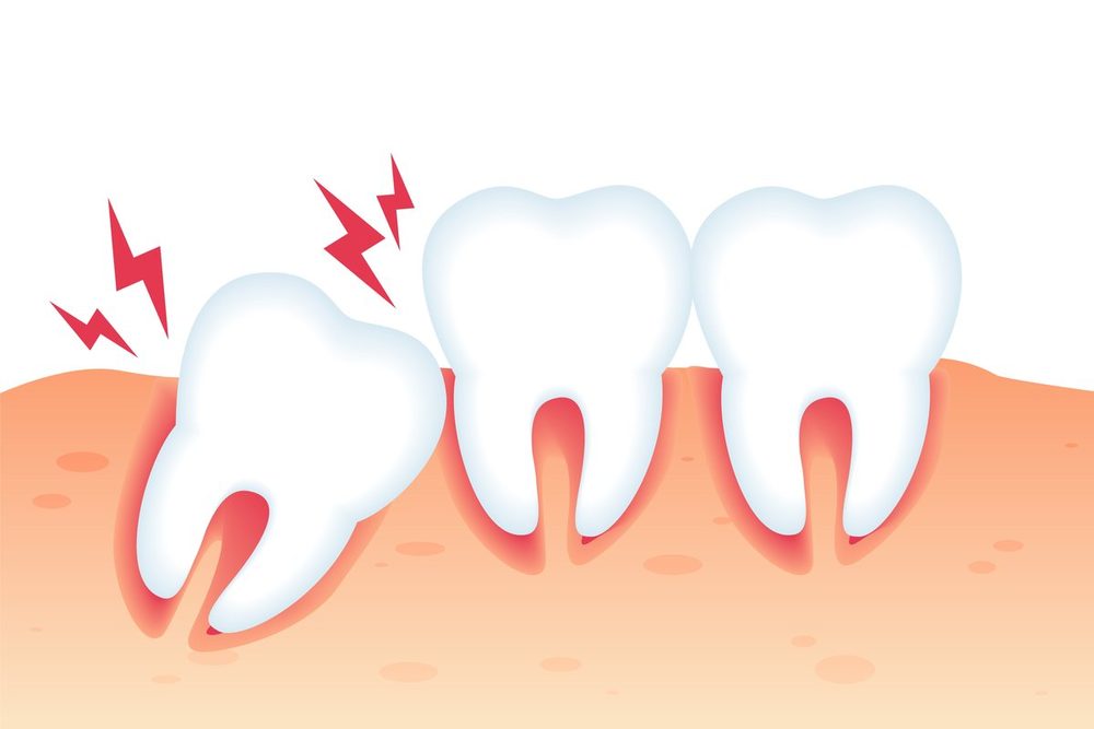 Is Wisdom Tooth Extraction Truly Necessary?