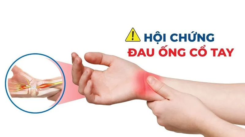Carpal Tunnel Syndrome