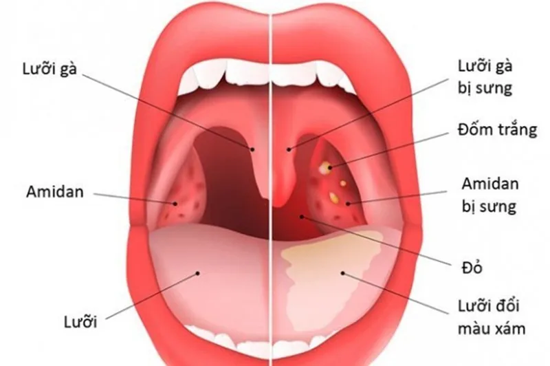 What is tonsillitis? Causes, symptoms, and treatment methods