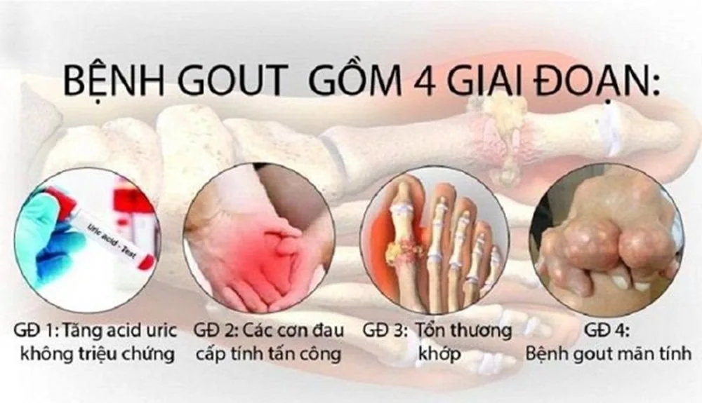 Gout: No Longer Exclusively a Disease of Affluence