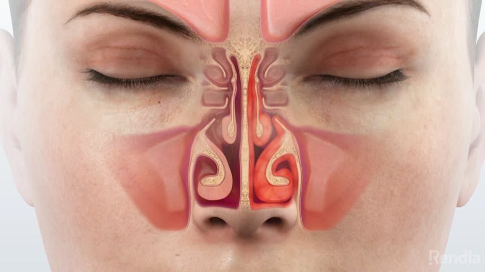 Rhinosinusitis and Its Unforeseen Complications