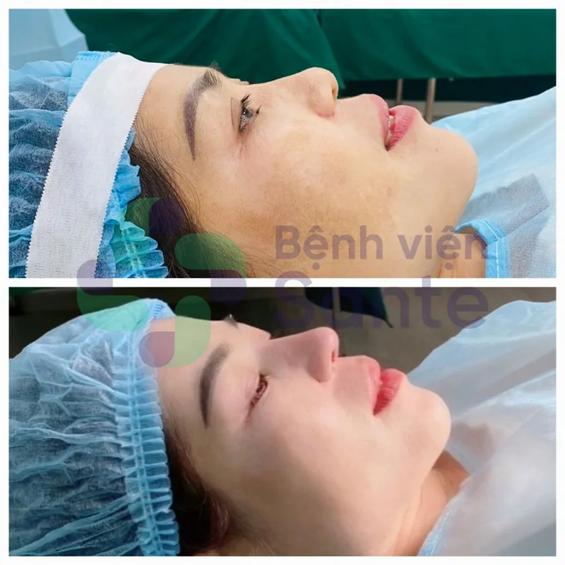 Aesthetic Rhinoplasty & Nasal Reconstruction – Sante Surgical Hospital