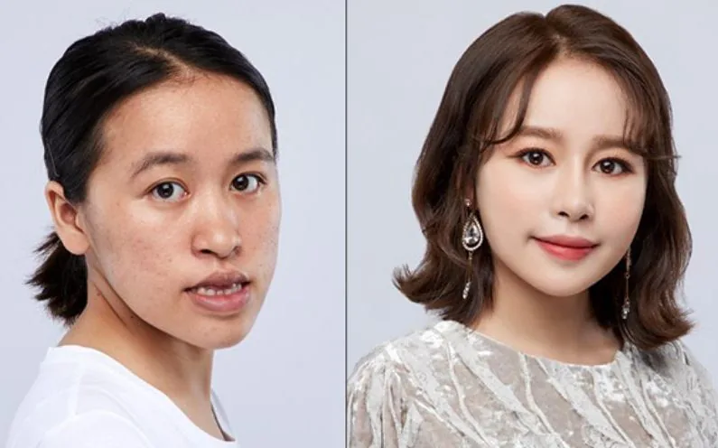 Sante Hospital - Plastic surgery completely transforms facial appearance (Figure 2) Sante Hospital - Plastic surgery completely transforms facial appearance (Figure 2)