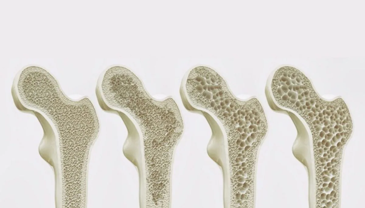 EARLY DETECTION OF OSTEOPOROSIS FOR OPTIMAL BONE HEALTH PRESERVATION - Image 3 - SANTE Hospital, Binh Thanh, HCMC