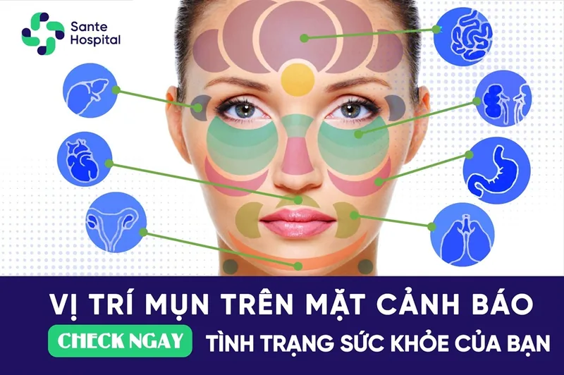 Facial Acne Mapping: Diagnostic Health Indicators Revealed by Breakout Zones - SANTE Hospital, Binh Thanh, HCMC