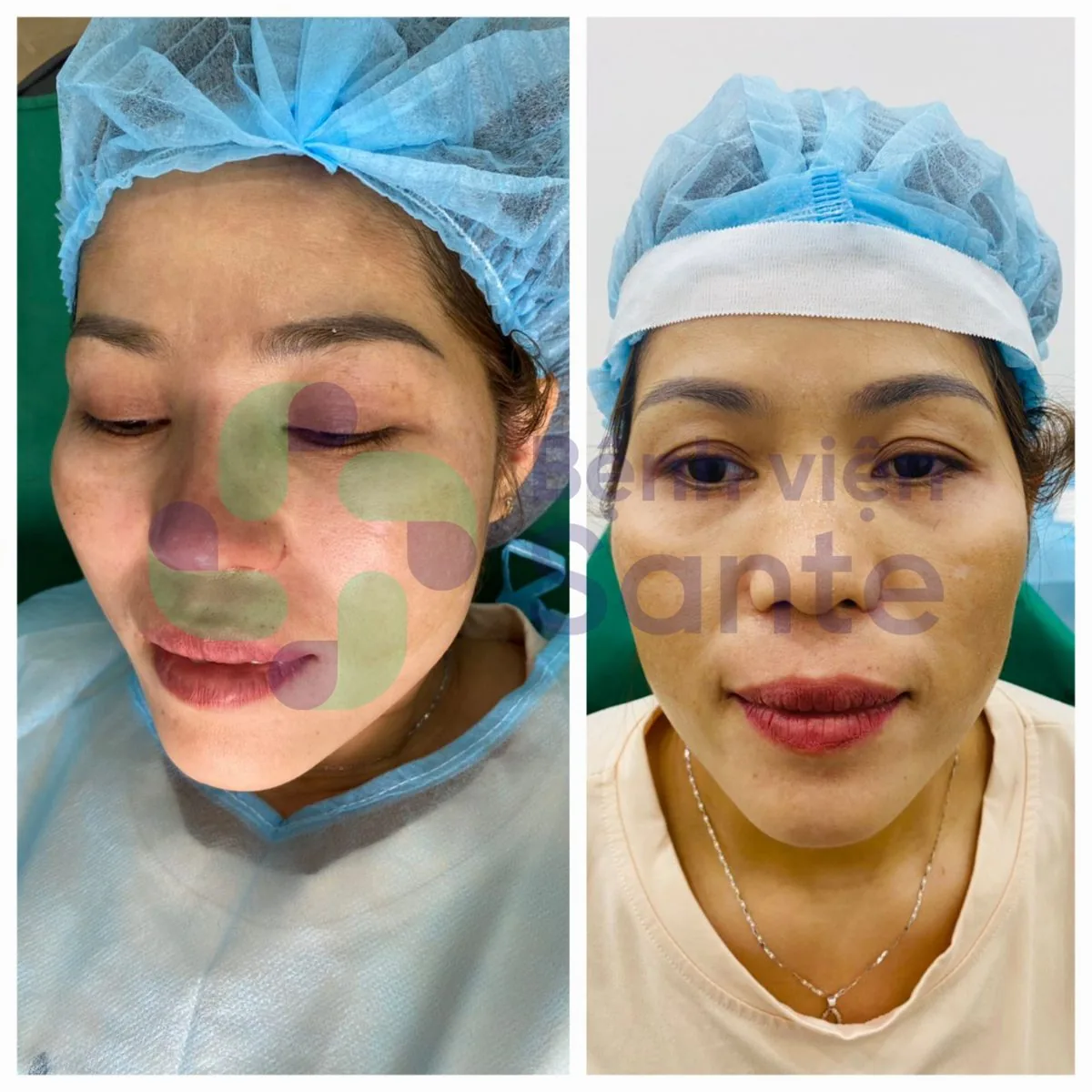 What Is Rhinoplasty? Premier International-Standard Rhinoplasty Hospital in HCMC - Figure 2 What Is Rhinoplasty? Premier International-Standard Rhinoplasty Hospital in HCMC - Figure 2