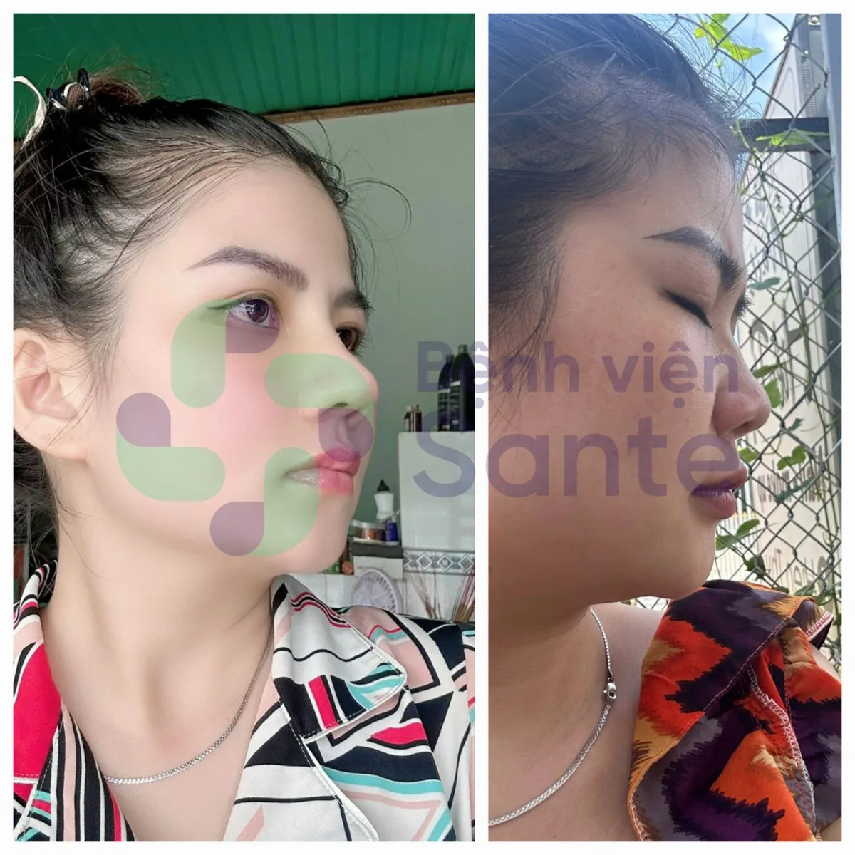 What Is Rhinoplasty? Premier International-Standard Rhinoplasty Hospital in HCMC - Figure 3 What Is Rhinoplasty? Premier International-Standard Rhinoplasty Hospital in HCMC - Figure 3