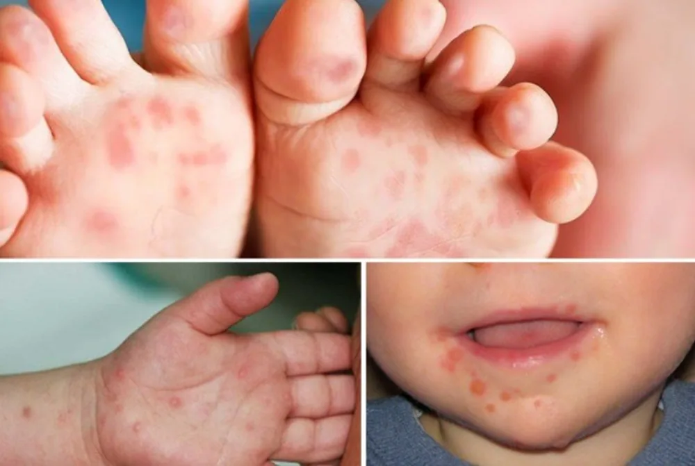 PREVENTING HAND, FOOT, AND MOUTH DISEASE IN CHILDREN - Image 2 - SANTE Hospital, Binh Thanh, HCMC