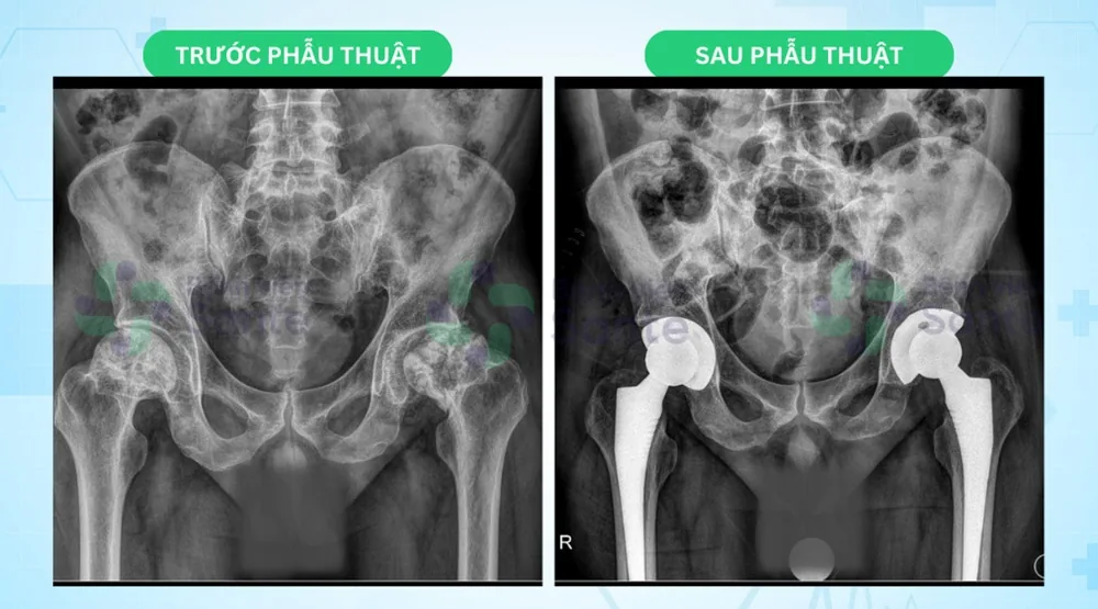 Returning for Contralateral Hip Replacement After 1 Month - Image 2 - SANTE Hospital, Binh Thanh, HCMC Returning for Contralateral Hip Replacement After 1 Month - Image 2 - SANTE Hospital, Binh Thanh, HCMC