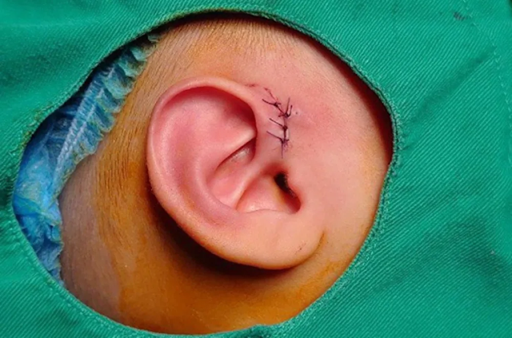 Preauricular Sinus: Essential Insights - Image 2 - SANTE Hospital Binh Thanh, HCMC Preauricular Sinus: Essential Insights - Image 2 - SANTE Hospital Binh Thanh, HCMC