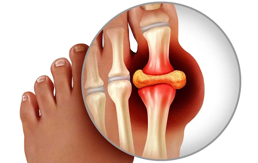 From Severe Pain to Loss of Mobility: The Consequences of Neglecting Gout Treatment - Image 2 - SANTE Hospital, Binh Thanh District, HCMC From Severe Pain to Loss of Mobility: The Consequences of Neglecting Gout Treatment - Image 2 - SANTE Hospital, Binh Thanh District, HCMC