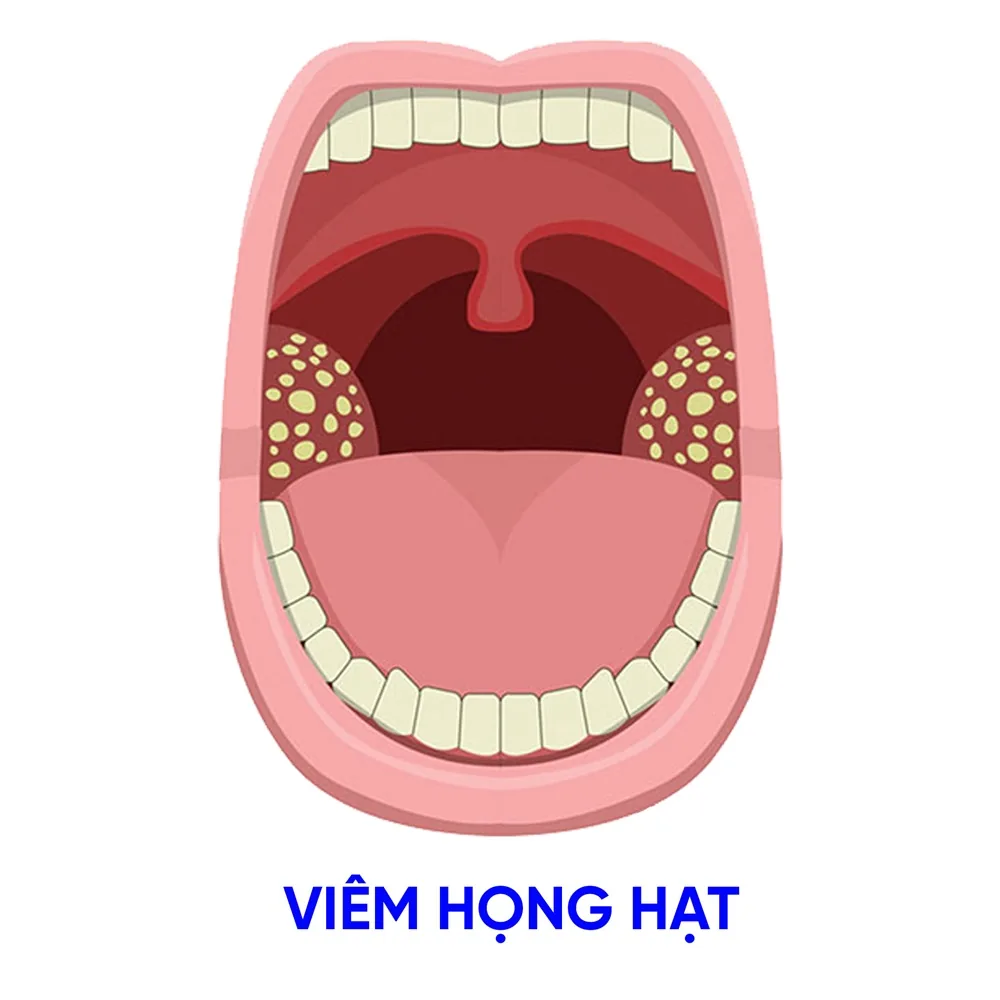 Granular Pharyngitis: Causes, Diagnosis, and Treatment - Image 2 - SANTE Hospital, Binh Thanh District, HCMC