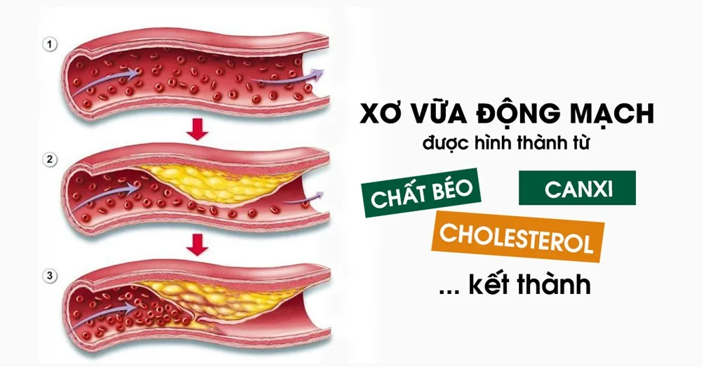 Atherosclerosis: A Silent Life-Threatening Risk - Image 2 - SANTE Hospital, Binh Thanh District, HCMC