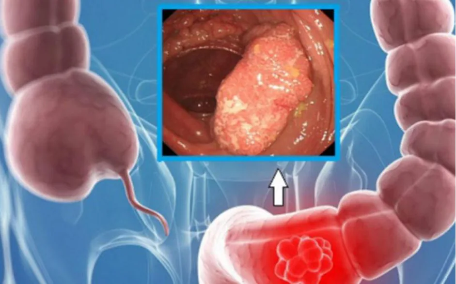 Colorectal Cancer Screening Modalities - Image 2 - SANTE Hospital, Binh Thanh, HCMC
